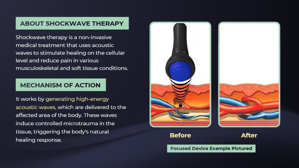 Diagram explaining shockwave therapy and its mechanism of action, with before and after illustration of tissue treated by a focused device